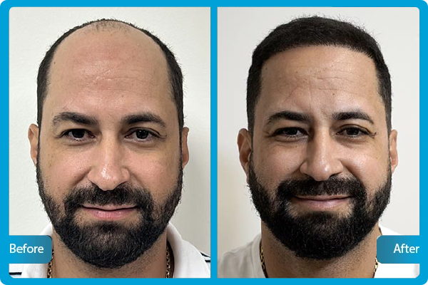 Haartransplantation Turkei Vorher Nachher​ 2