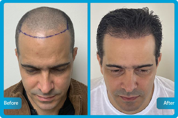 Haartransplantation Turkei Vorher Nachher​ 3