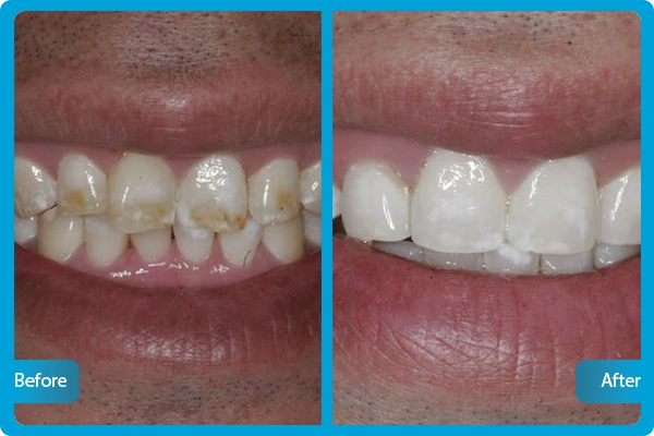 Zahnbleaching Türkei Vorher Nachher