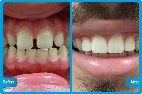 Zahnveneers Türkei Vorher Nachher