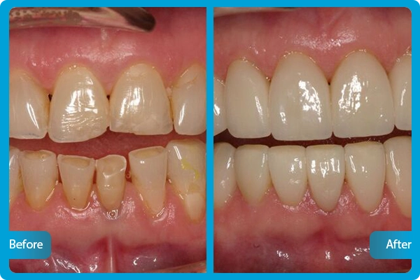 Zahnveneers Türkei Vorher Nachher