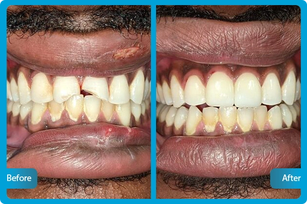 Zahnveneers Türkei Vorher Nachher