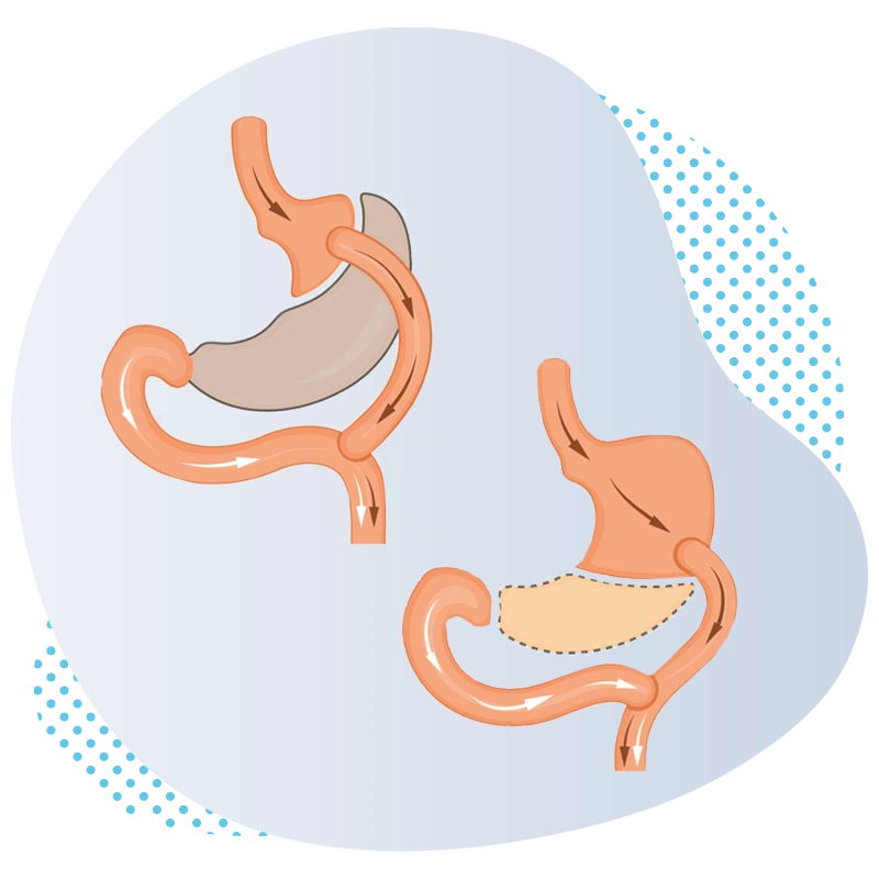 Bariatrische Revision