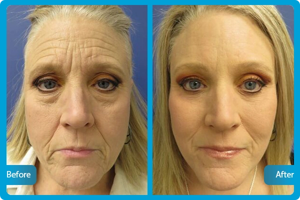 facelift turkei vorher nachher 1
