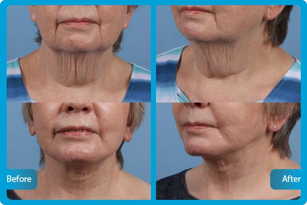 facelift türkei vorher nachher