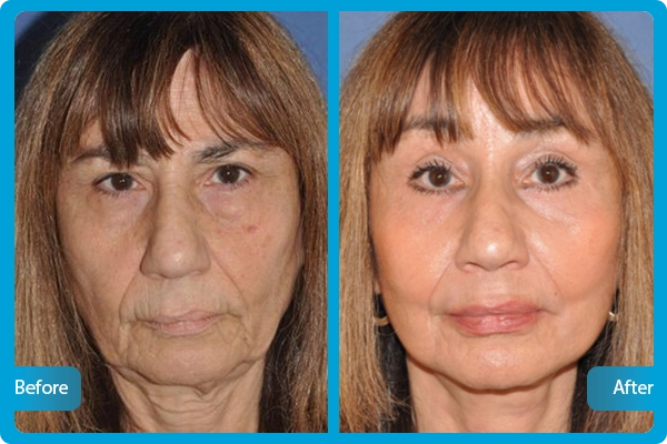 facelifting türkei vorher nachher