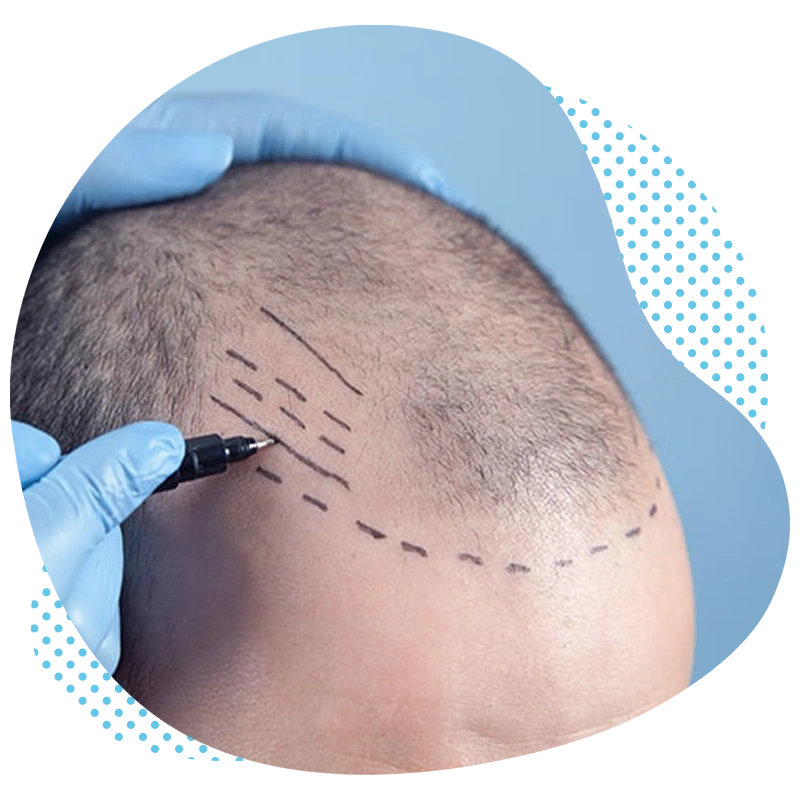 Fue haartransplanataion türkei antalya kosten ablauf