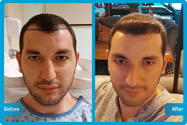 haartransplantation vorher nachhe