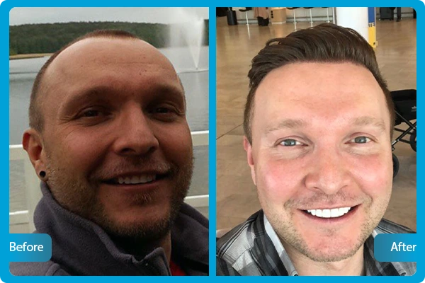 haartransplantation-vorher-nachher