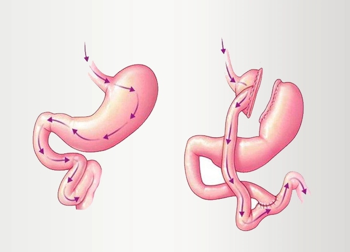 roux-y-magenbypass-turkei