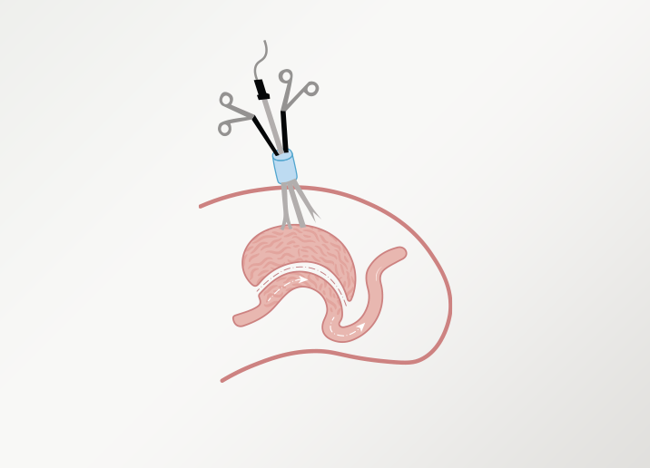 Single Incision Laparoscopic Surgery Turkey