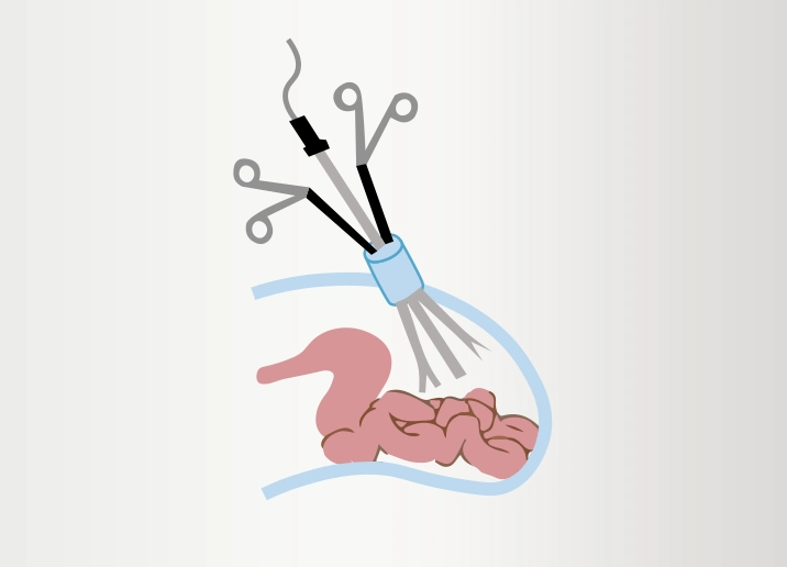 single-incision-laparoscopic-surgery-turkei