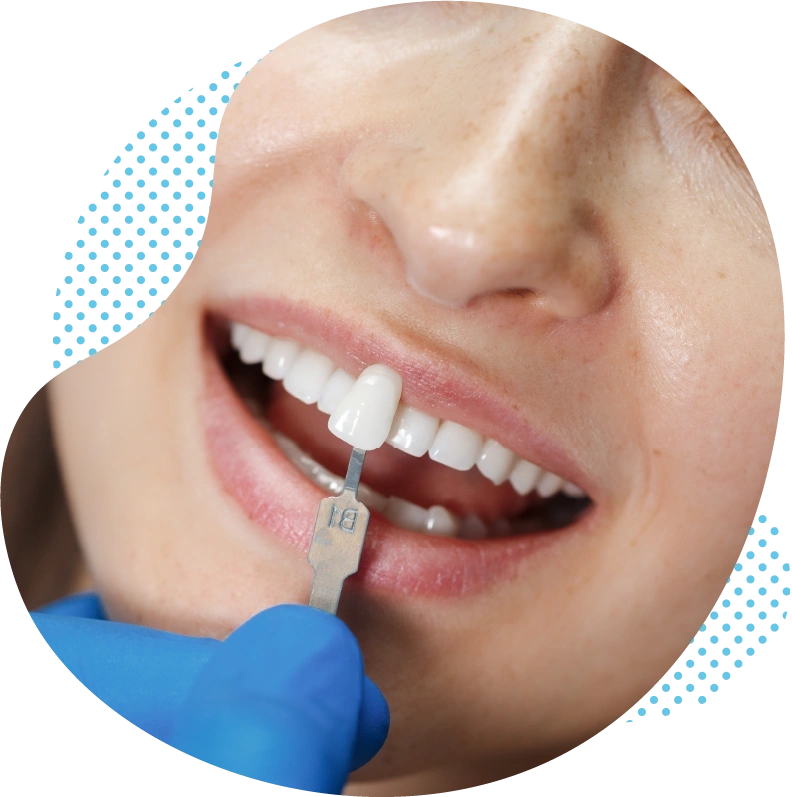 Zahnveneers türkei kosten