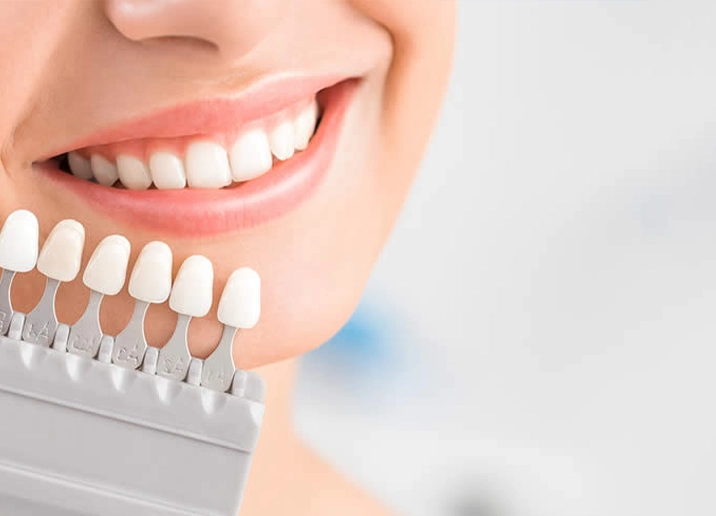 Zahnveneers türkei